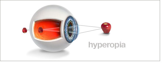 eye hyperopia