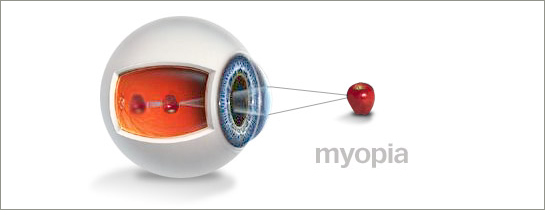 eye myopia